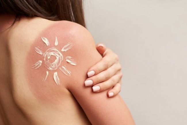«Злое солнце»: врачи назвали ТОП-5 ошибок при солнечных ожогах