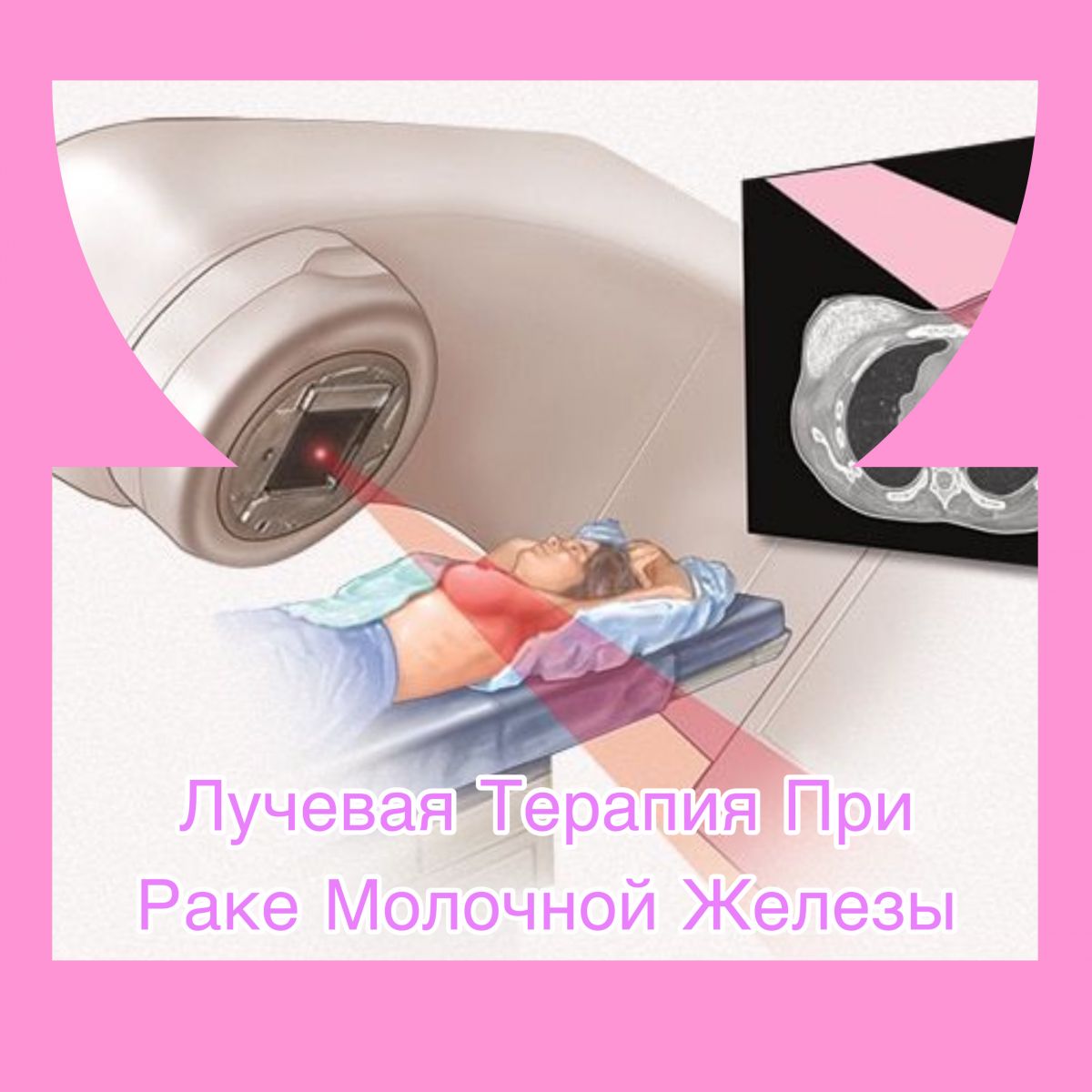 Когда показана лучевая терапия при раке молочной железы?