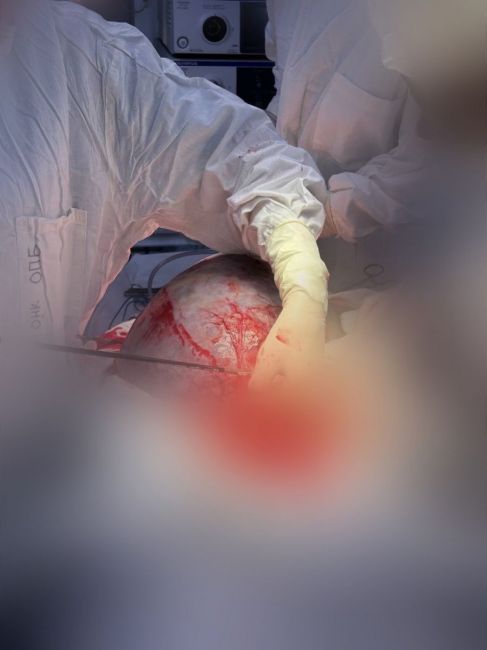 Тульские врачи избавили пациентку от гигантской опухоли яичника