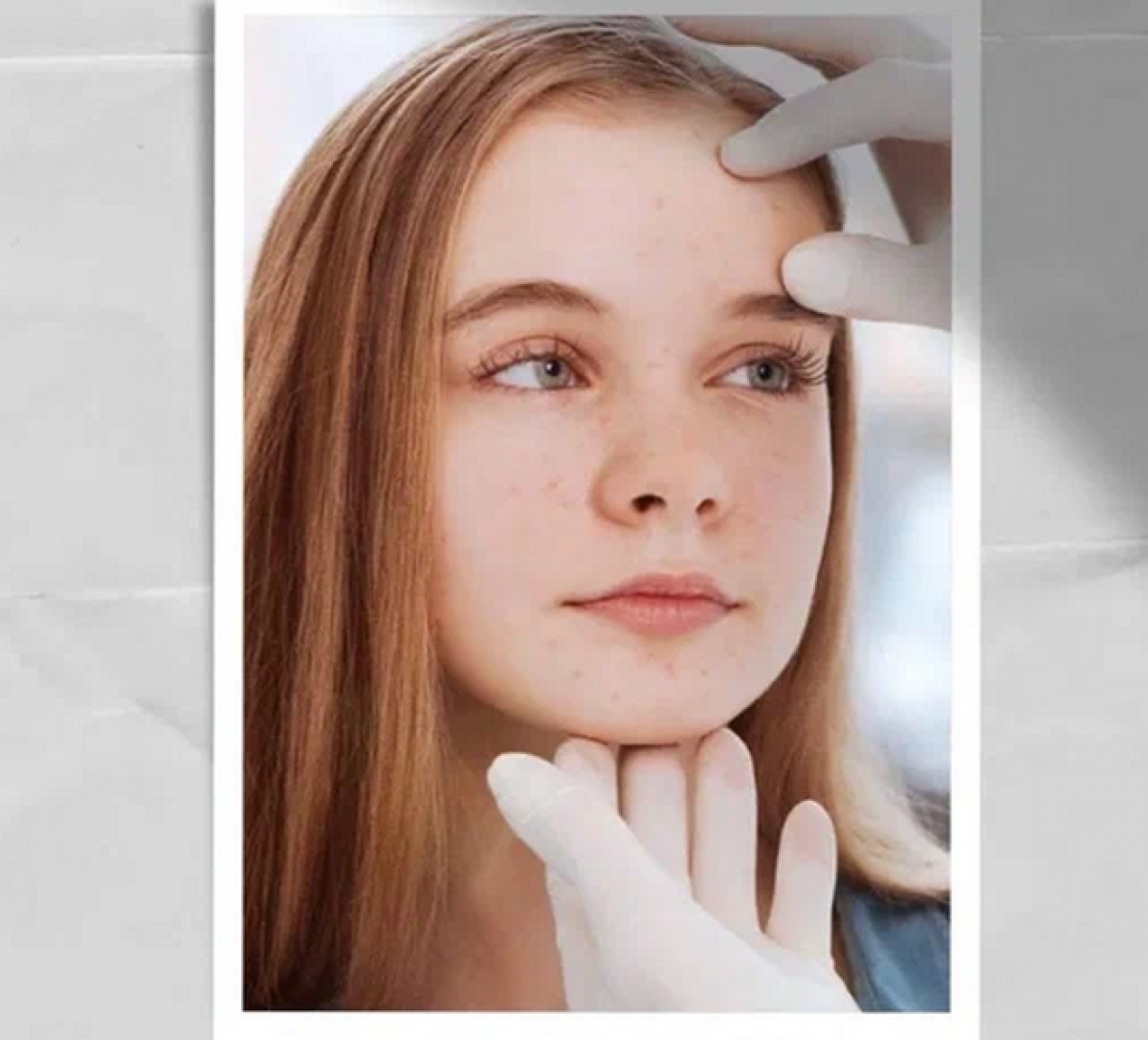 Проблемная кожа у подростков, что важно знать Проблемная кожа у подростков, что важно знать