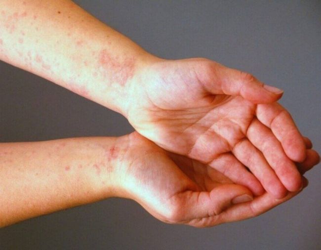 Контактный дерматит: аллергия от прикосновения
